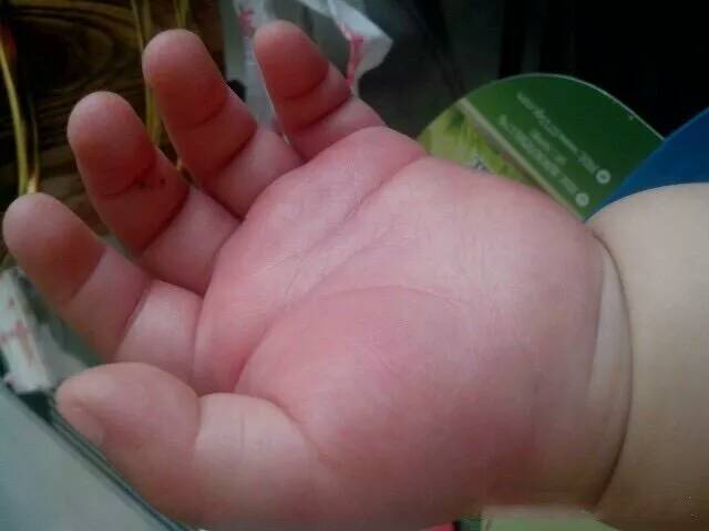 8个月宝宝手背突然很肿,11个月的宝宝手指突然红肿