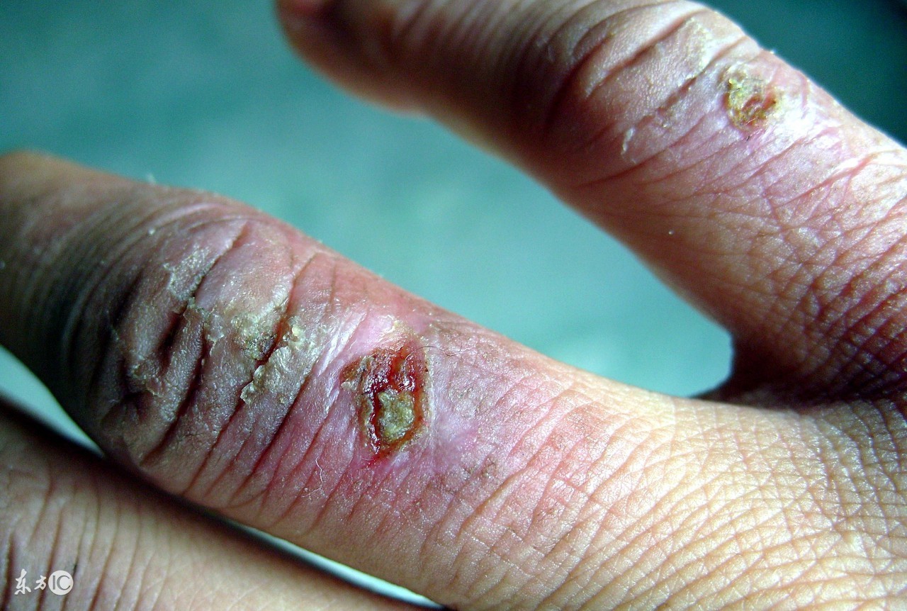 妙!防治各类冻疮的16种中成药