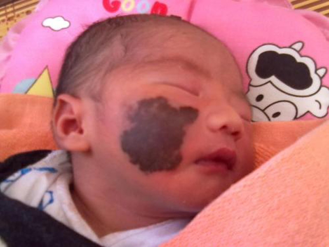 新生儿胎记判断,新生儿胎记种类都有哪些