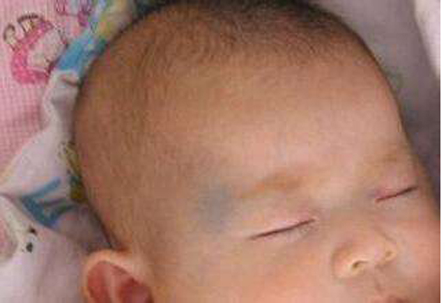 新生儿胎记判断,新生儿胎记种类都有哪些