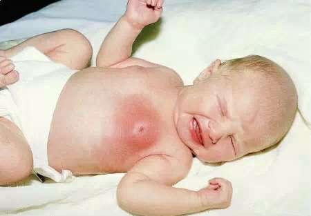 宝宝月子期间被婆婆挤破奶头，大夫检查后，怒斥婆婆无知