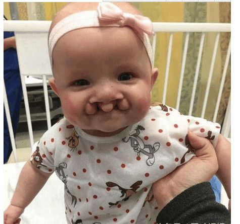 怀孕5个月了查出宝宝兔唇,孕妈没有按时产检娃有兔唇