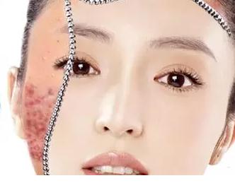 敏感肌过敏怎么修复角质层薄,过敏肌怎么修复皮肤屏障