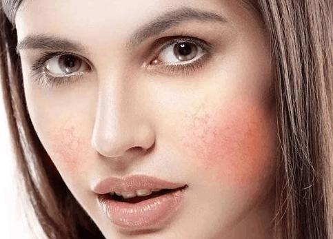 脸上皮肤经常过敏是激素脸吗？怎样才能知道自己是不是激素脸