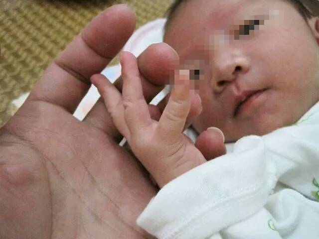 8个月宝宝手背突然很肿,11个月的宝宝手指突然红肿