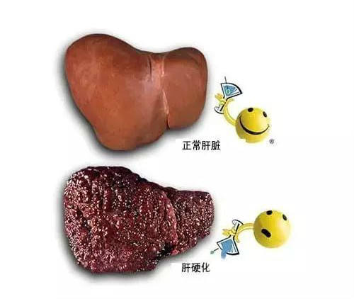 肝硬化晚期的4种并发症要警惕,肝硬化吐血发病前怎么预防