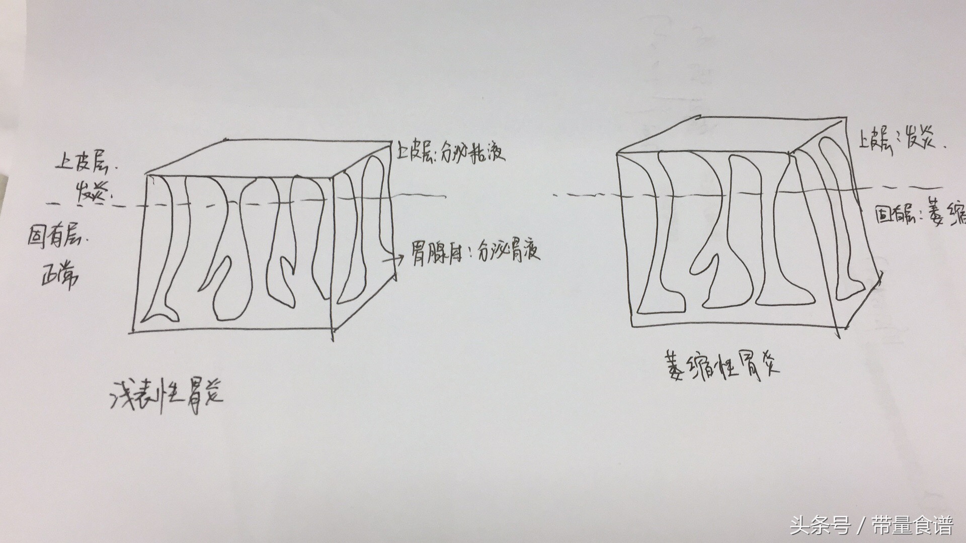浅表性胃炎饮食表,有浅表性胃炎一日三餐怎么吃