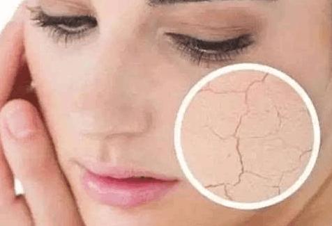 脸上皮肤经常过敏是激素脸吗？怎样才能知道自己是不是激素脸