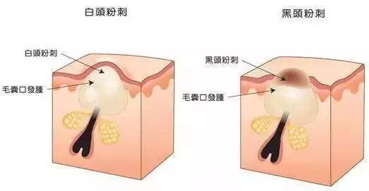 “闭口”这么烦人该如何解决?种草这些好物!