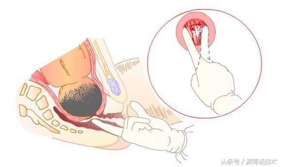顺产开十指是十根手指宽吗,顺产开十指是多少