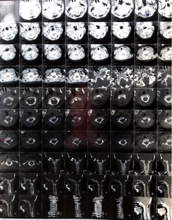 宝宝从床上摔下眼睛肿怎么回事,宝宝从床上摔下来眼睛肿了好大