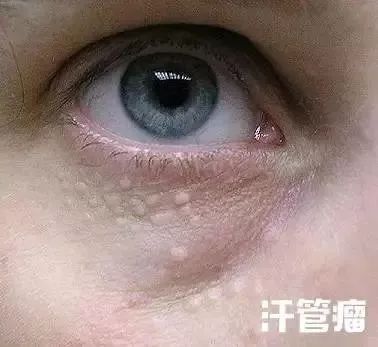 眼霜脂肪粒会自动消失吗,用眼霜长脂肪粒怎么办要怎么处理