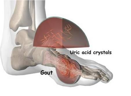 老公痛风吃药对妻子有影响吗,老公痛风走不了路