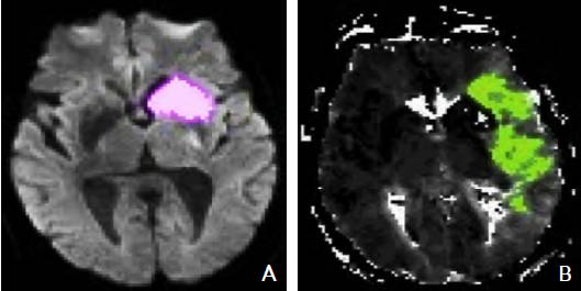 2017急性缺血性卒中血管内治疗影像评估中国专家共识