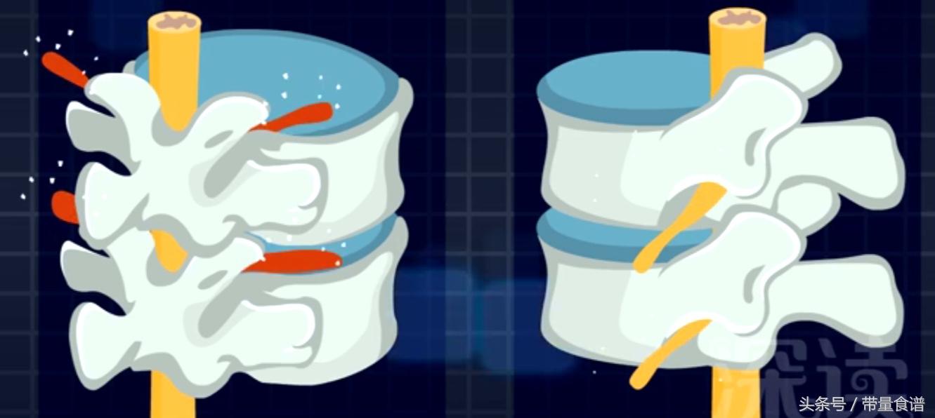 坐不久站不久用什么治疗,刚刚腰椎间盘突出怎么办