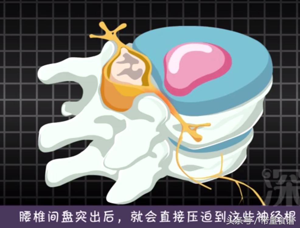 坐不久站不久用什么治疗,刚刚腰椎间盘突出怎么办