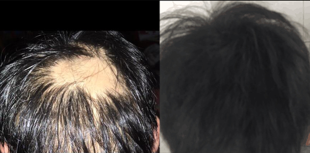 掉头发是什么原因引起的脱发,额头脱发的原因和治疗方法