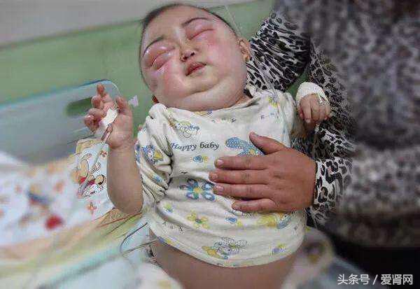 宝宝肾病可以治好吗,孩子得了肾病要紧吗