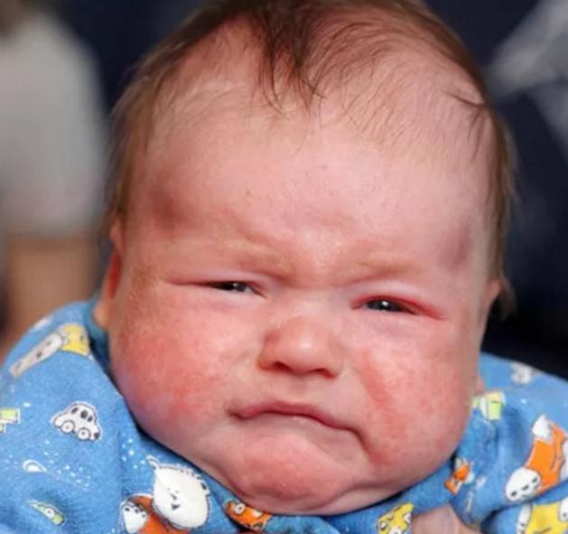 宝宝过敏怎么办家长应做好这几点,宝宝过敏怎么办最快最有效