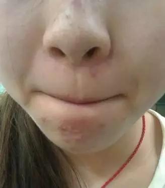 痘痘类皮肤的护理方法有哪些,痘痘肌肤的8个护理方式