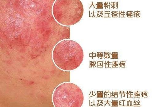 激素脸皮炎最佳治疗方法,脸部激素性皮炎怎么治疗才能好