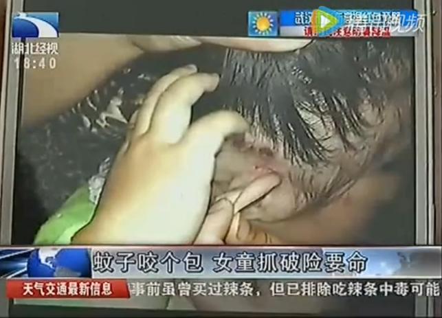 小孩大腿起水泡,孩子大腿起水泡