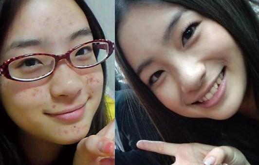 怎么对付泛红的痘印,混油痘用什么祛痘最好