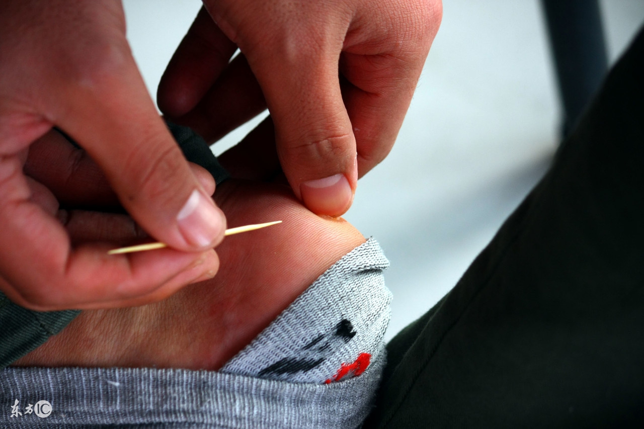 小孩大腿起水泡,孩子大腿起水泡