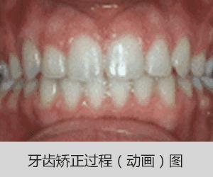 牙齿矫正得越快价格会越便宜吗,年龄越小牙齿矫正越快吗