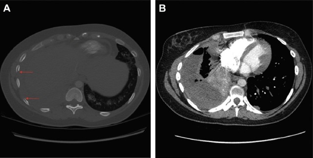 病例讨论：宫颈癌患者为何出现呼吸急促和胸痛？