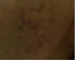 痘痘类皮肤的护理方法有哪些,痘痘肌肤的8个护理方式