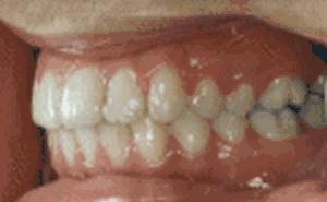 牙齿矫正得越快价格会越便宜吗,年龄越小牙齿矫正越快吗