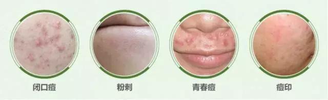 痘痘类皮肤的护理方法有哪些,痘痘肌肤的8个护理方式