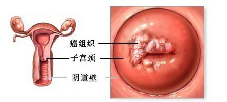 ”红颜杀手”——宫颈癌发病趋向年轻化！