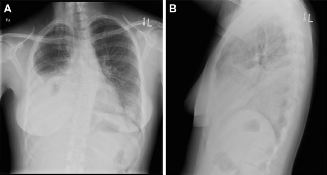 病例讨论：宫颈癌患者为何出现呼吸急促和胸痛？