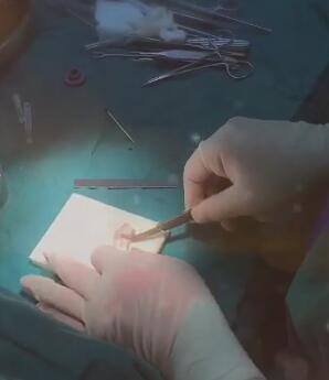 鼻综合隆鼻用什么材料,耳软骨和肋骨隆鼻费用多少钱