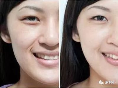 法令纹可以通过护肤品改善吗,有护肤手法真的能淡化法令纹吗