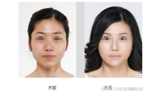 激光黑脸娃娃多少钱,激光美肤用黑脸娃娃效果好吗