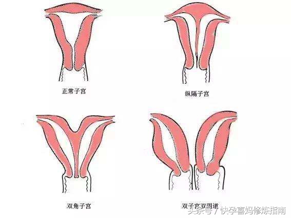好事有成双，生娃有成双，你见过子宫成双的吗？双子宫妈妈的分享