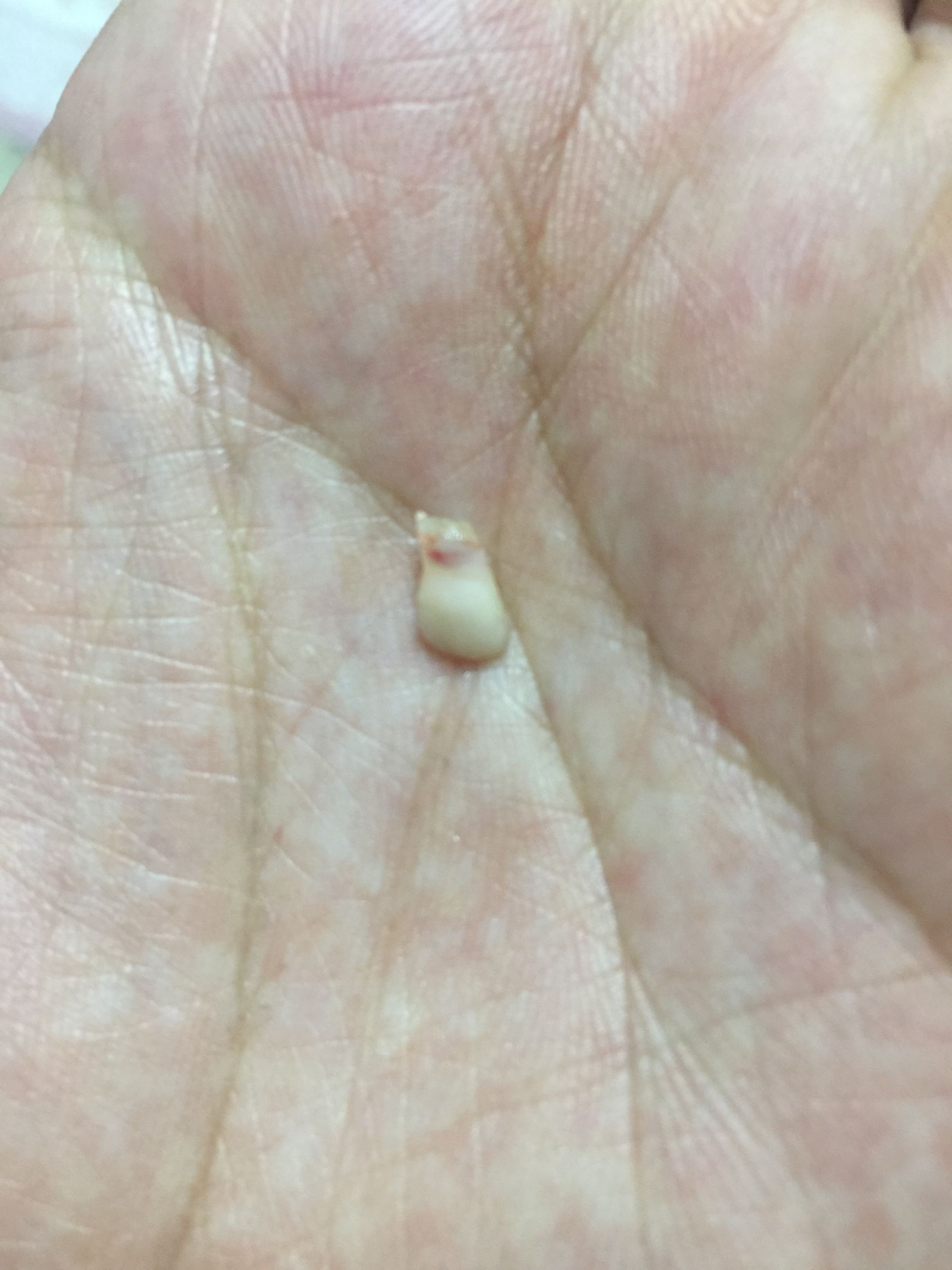 小朋友掉了牙齿牙龈有点肿,女儿7岁了门牙掉了牙床红肿