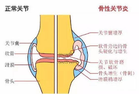 民间治疗骨性关节炎的妙方,得了骶髂关节炎怎么办