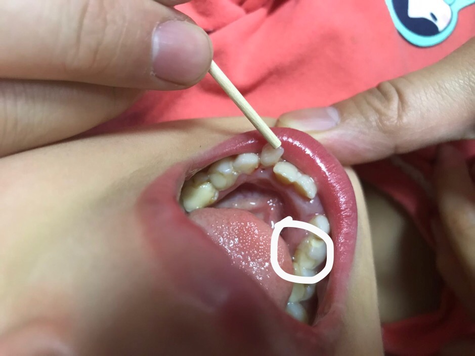 小朋友掉了牙齿牙龈有点肿,女儿7岁了门牙掉了牙床红肿