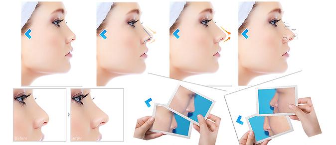 线雕隆鼻山根变宽,线雕隆鼻的危害和后遗症