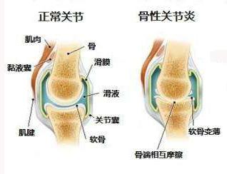 民间治疗骨性关节炎的妙方,得了骶髂关节炎怎么办