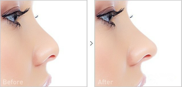 线雕隆鼻山根变宽,线雕隆鼻的危害和后遗症