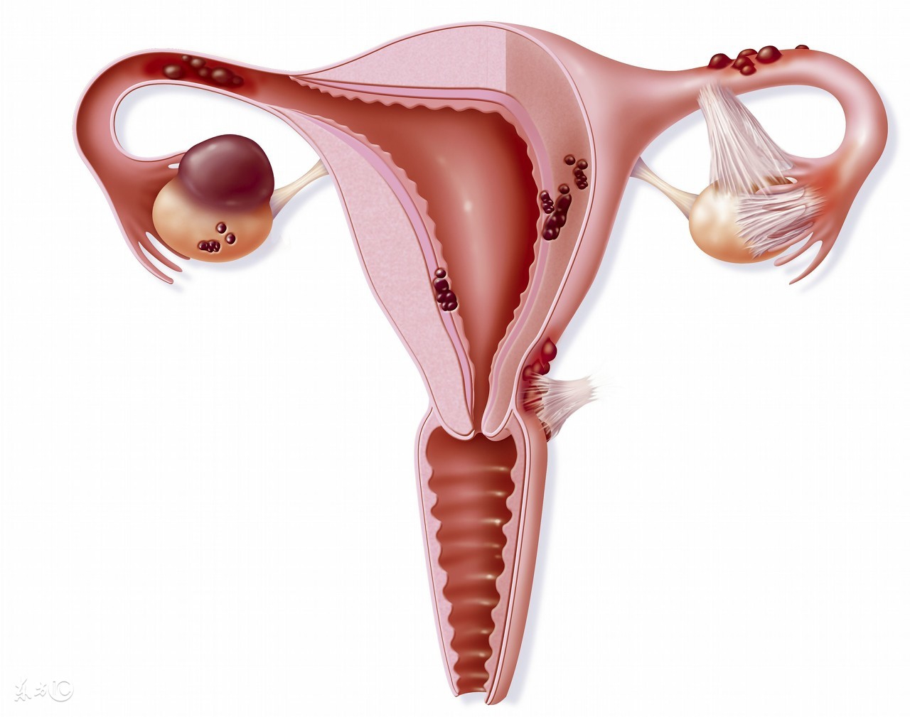 子宫内膜结核是什么原因造成的,子宫内膜结核什么原因引起呢