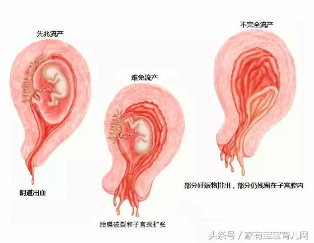 流产影响二胎吗,流产影响以后怀孕吗
