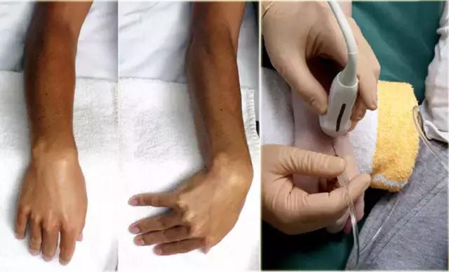 超声引导下穿刺手法解析,超声介入穿刺和普通穿刺的区别