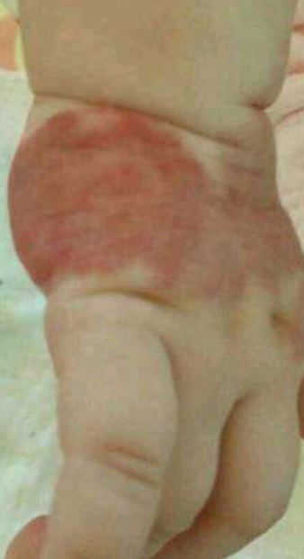 宝宝出生就有胎记是宝妈的原因吗,宝宝有胎记的宝妈们都去了吗