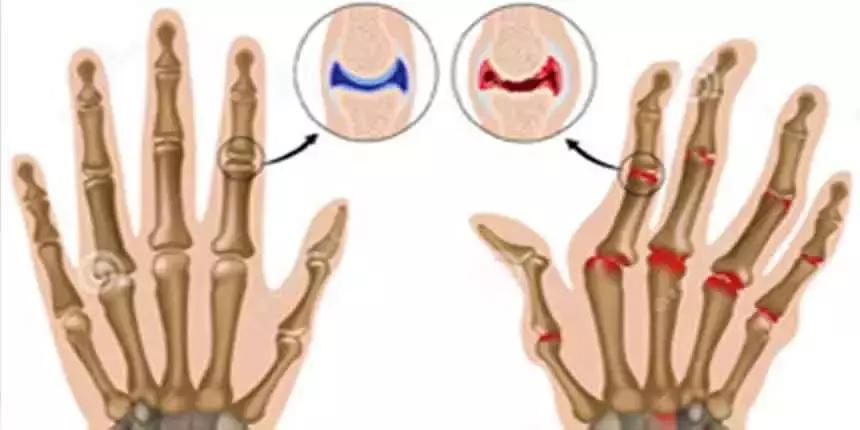 穿好奶奶织的毛裤,你依旧无法避免与风湿膏药共度晚年